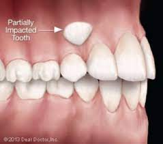 Exposure Of Impacted Canine Teeth North Shore Periodontics Impacted Tooth Periodontitis Dental Services