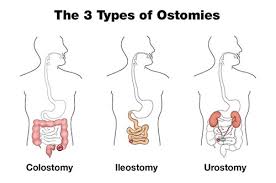 There is no pain and very little discomfort, but it is becoming slowly larger and without wearing my stoma belt, it would be very unsightly. The 3 Types Of Ostomies Hollister Us
