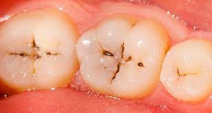 Video How To Easily Heal Cavities From Home Heal Cavities Cavities Cure Tooth Decay