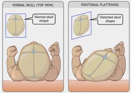 Image result for Positional Head Deformity