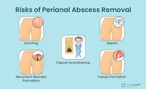 Image result for Perianal Abscess