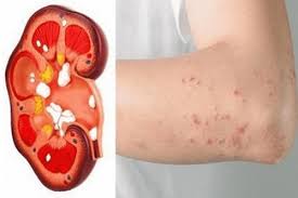 8 dấu hiệu suy thận giai đoạn đầu bạn không nên bỏ qua