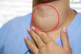 The first sign of it is usually the appearance of a painless lump in the front of a person's neck. These Symptoms Which Appear Harmless Could Be A Sign Of Thyroid Cancer