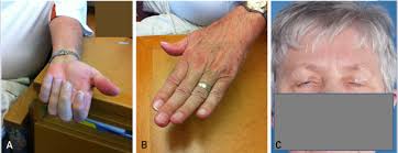 Check spelling or type a new query. Diagnosis And Management Of Immune Mediated Myopathies Mayo Clinic Proceedings