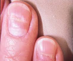 Image result for Beau lines feet