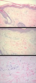 It often occurs on the hands, forearms, and legs. Sunburn Purpura Mdedge Dermatology