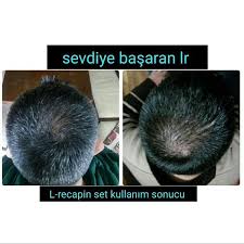 2 Aylik Recapin Set Ve Sprey Kullanim Sonucu Sac Sacbakimi Sacdokulmesi Sacdokulmesineson Kellik Kelligeson Sacsorunu Sac Sac Kuaforler Sac Dokulmesi