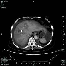 Computed Tomography Findings Of Hepatic Veno Occlusive Disease Caused By Sedum Aizoon With Histopathological Correlation