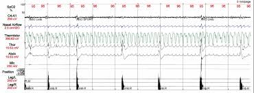 Image result for Polysomnogram