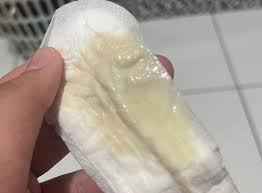 corrimento anormal | BabyCenter