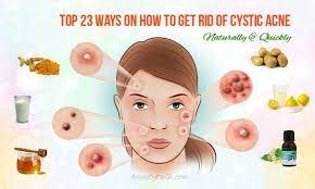 Check spelling or type a new query. Top 23 Ways On How To Get Rid Of Cystic Acne Naturally Quickly Cystic Acne Cystic Acne Treatment Hormonal Acne