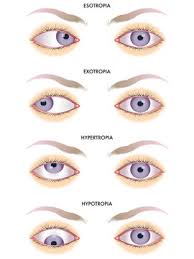 With approximately 1.2 million procedures each year. Strabismus Photos Royalty Free Images Graphics Vectors Videos Adobe Stock
