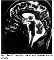 Scielo Brasil Neurological Manifestations Of Celiac Disease Neurological Manifestations Of Celiac Disease
