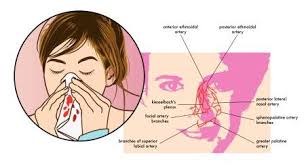 Image result for Epistaxis