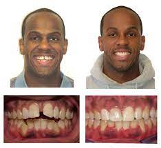 Pin On Invisilign And Bleaching