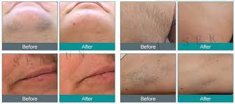 To make an appointment please go to the contact page. Seasun Laser Painless Permanent Armpit Hair Epilator Machine Electrolysis Hair Removal Machine With Needle Buy Electrolysis Hair Removal Machine With Needle Epilator Machine Electrolysis Hair Removal Machine With Needle Hair Epilator Machine Electrolysis