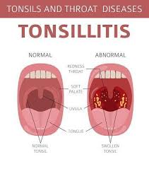 Learn about tonsillectomy with free interactive flashcards. What Is A Tonsillectomy