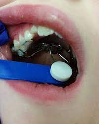 5 Things I D Tell You About Wearing A Palatal Expander From An 8 Year Old S Perspective Living The Diagnosis Soft Food For Braces Braces Food Expanders For Teeth
