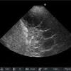 Often, pleural effusions are found incidentally on chest radiographs requested for another acute problem (e.g. 1