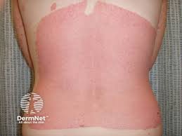 Image result for koebner phenomenon psoriasis