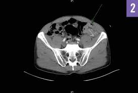 Image result for Adult Intussusception