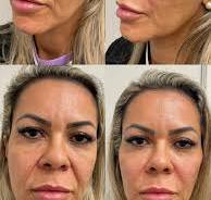 Linhas suavizadas e rosto mais harmônico! 🤩 O preenchimento ...
