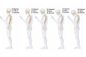 Name for hump.in back.of nevck. Is Your Smartphone Giving You The Hump Physiotherapy Posture And Fitness Clinic