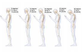 Neck hump or buffalo hump. Is Your Smartphone Giving You The Hump Physiotherapy Posture And Fitness Clinic