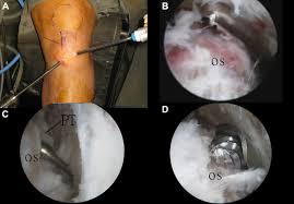 Endoscopic Management Of Osgood Schlatter Disease Sciencedirect