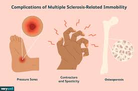 Multiple sclerosis (ms) is a chronic, inflammatory, noninfectious disease that affects the central nervous system (cns). Sores Contractures And Osteoporosis Due To Ms Immobility