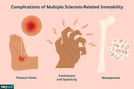 In ms the body's immune system attacks myelin, which coats nerve cells. Sores Contractures And Osteoporosis Due To Ms Immobility