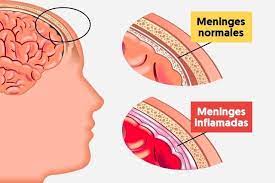 Representación de la enfermedad meningitis