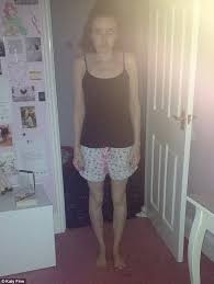 Anorexic OCD sufferer set up fake Facebook pages for friends she invented