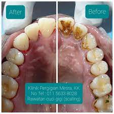 Biaya pasang behel, harga spesial bleaching, veneer, crown, bridge, tambal, cabut, pembersihan karang gigi, dan perawatan lainnya. Rawa Klinik Pergigian Mesra Kota Kinabalu Bandar Sierra Facebook