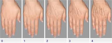 How to get rid of wrinkles on hands. Everything You Need To Know About Hand Rejuvenation Zwivel