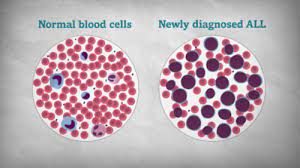 Jun 21, 2021 · en cuanto al perfil del paciente, depende mucho del tipo de leucemia. Leucemia Linfoblastica Aguda Lla En Ninos Y Adolescentes Juntos