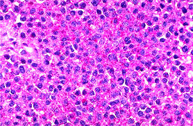 Merkel cell carcinoma is a type of skin cancer. Pathology Outlines Ewing Sarcoma Pnet