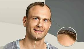 List Of Best Laser Hair Removal Treatment in Asif Nagar