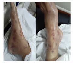 Image result for Panniculitis
