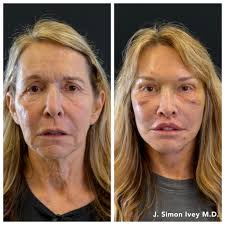 Has anyone here had a facelift by either Mendoza or espino?