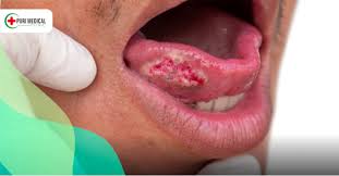 Image result for gum cancer symptoms