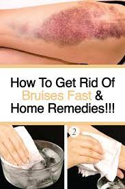 Pin On Home Remedies And Natural Cures