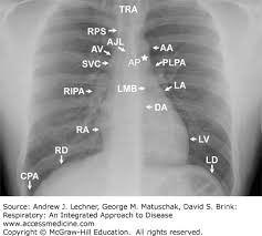 Image result for Chest XRay Interpretation