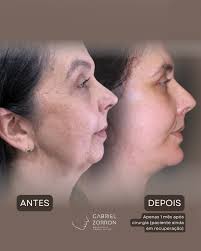 14 dias após cirurgia do Adrian Adrian cruzou o oceano vindo da Inglaterra  em busca de um rejuvenescimento que fosse além da estética — ele queria  recuperar estrutura, leveza e funcionalidade. Planejamos