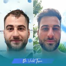 Leading Provider of Hair Transplantation Services in Turkey