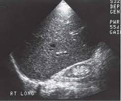 Before ultrasound study, patients were. Renal Failure Radiology Key