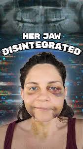 How do you fix a face that’s falling apart? In Rachel case, you break it  even more. , Rachel’s journey started with trouble swallowing, but what  doctors discovered was far worse—her jaw was literally ...