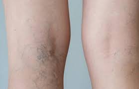 We did not find results for: Are Your Spider Veins Trying To Tell You Something Seniordirectory Com