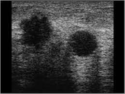 Breast And Axilla 5 2 Malignant Breast Lesions Case 5 2 7 Spreading Of Breast Cancer Multifocal And Multicentric Breast Cancer Ultrasound Cases