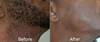 Laser hair removal prices are pretty steep. Laser Hair Removal New Orleans Cost Of Laser Hair Removal Etre